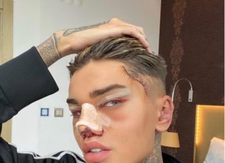 TikToker Says the Best Part of Plastic Surgery Is "Getting Content"
