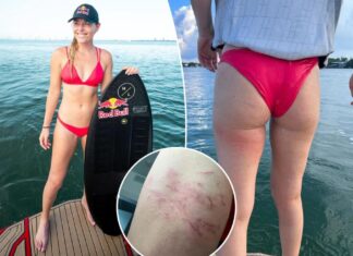 Lindsey Vonn reveals she was stung by jellyfish while wake surfing