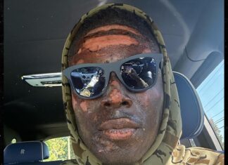 Browns' David Njoku Reveals Burned Face After Fire Pit Accident