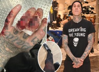 Travis Barker reveals bloody hand injury after Blink-182 show in England